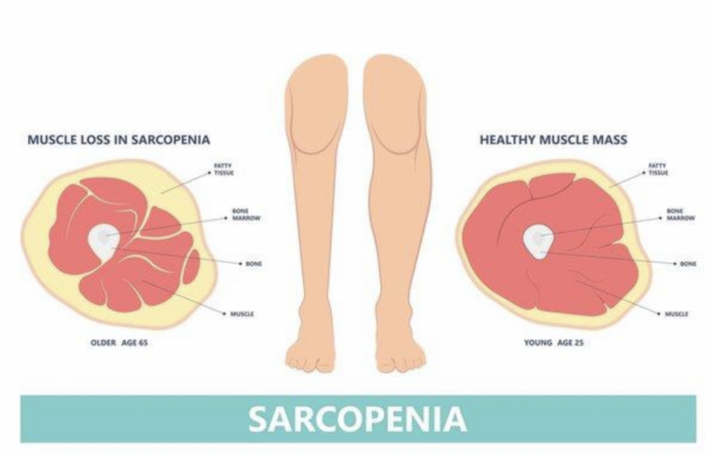 menopausia y sarcopenia