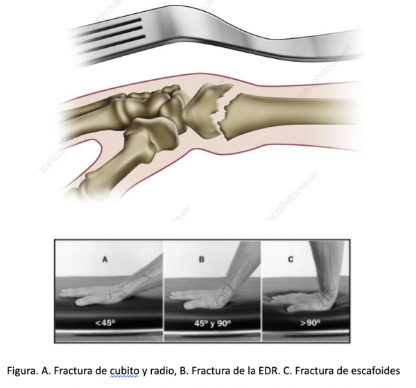 lesión deportiva mano